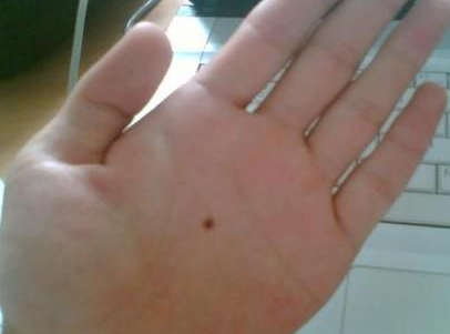 不管男女，痣长在哪里最幸运，有痣的人快来看看