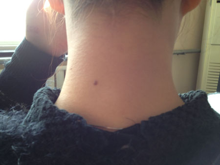 男人苦情痣长在哪里 男人苦情痣长在哪里