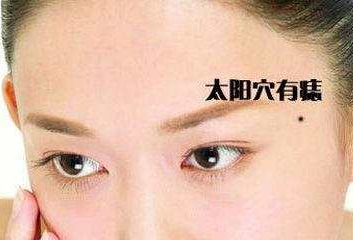 「痣」得八方财, 解析身体5处好运吉祥痣 「痣」得八方财, 解析身体5处好运吉祥痣