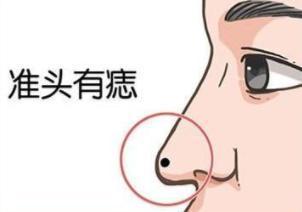 鼻子周围有痣好不好,鼻子上的痣看你是否富贵命 鼻子周围有痣好不好,鼻子上的痣看你是否富贵命