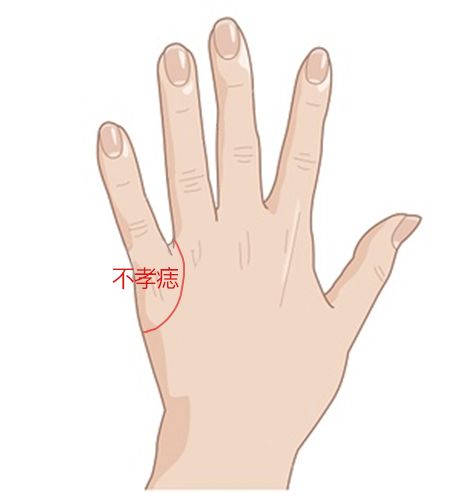 不孝痣 不孝痣