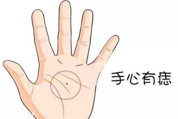 手心长痣意味着什么 手心长痣意味着什么