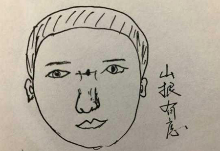 人身上的四处大恶之痣,让人霉运不断,婚姻不稳,一定不能留 人身上的四处大恶之痣,让人霉运不断,婚姻不稳,一定不能留