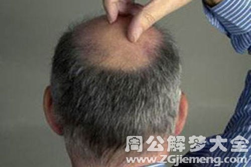 梦见自己头顶秃了